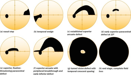 Diagram showing common glaucomatous visual field defect patterns