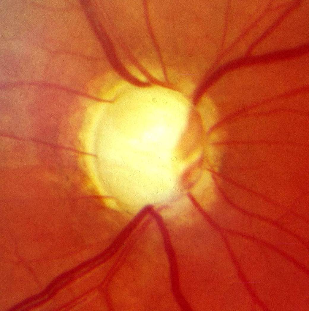 Fundus photo showing advanced glaucomatous cupping of the optic nerve head