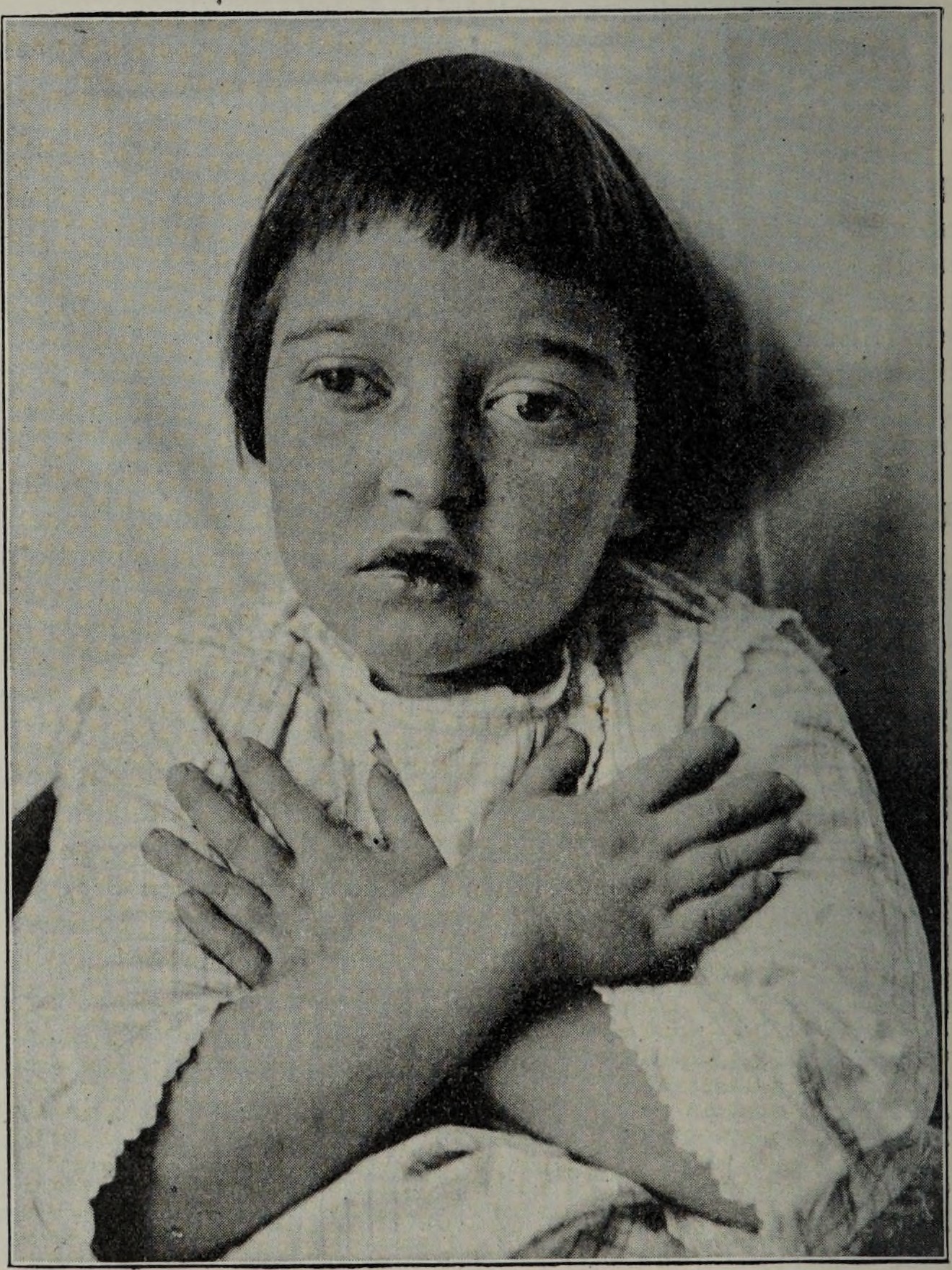 Historical photograph of a child with divergent eyes and nystagmus