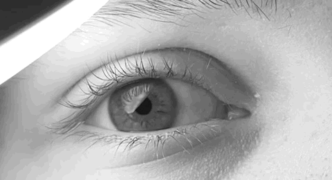 Animated GIF of rapid horizontal congenital nystagmus