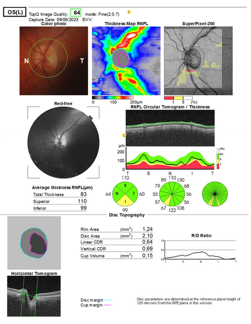Optic disc topography report with nerve fiber layer thickness maps