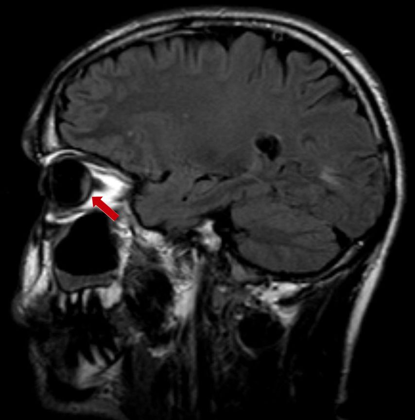 Sagittal MRI of the head with an arrow pointing to an intraocular mass consistent with uveal melanoma