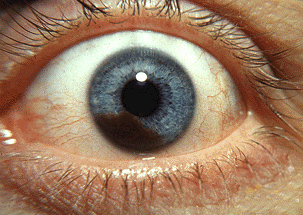 Close-up photograph of a blue eye with a dark brown lesion on the iris consistent with iris melanoma