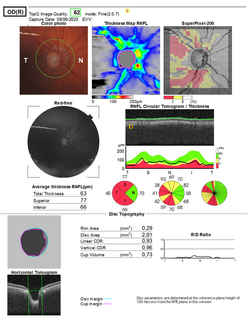 Optic disc OCT report showing glaucomatous cupping and RNFL thinning
