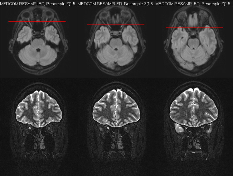 MRI slice highlighting T2 hyperintensity of the right optic nerve.