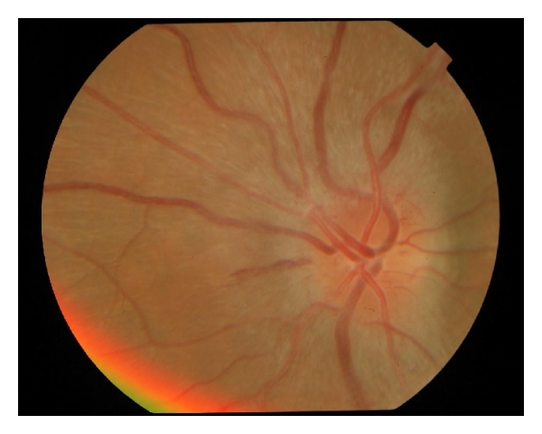 Fundus photograph showing a swollen optic disc in optic neuritis.