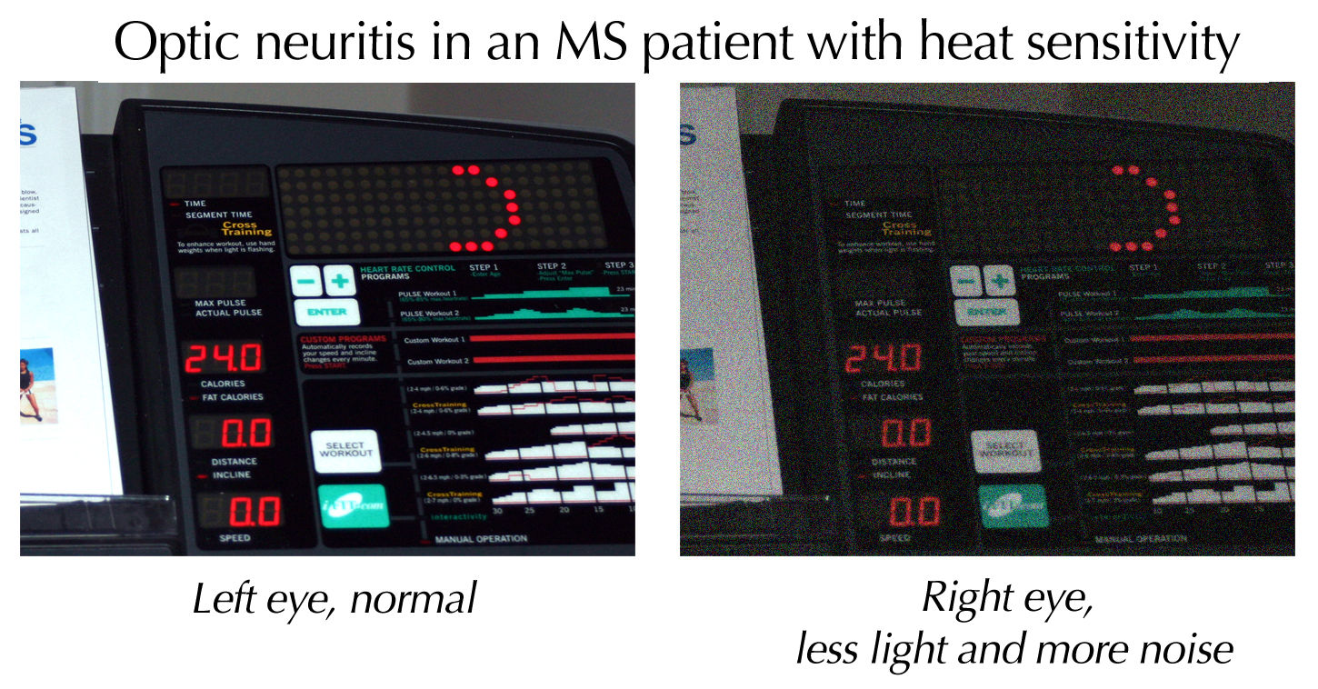 Side-by-side comparison simulating normal vision and vision through an eye with optic neuritis.