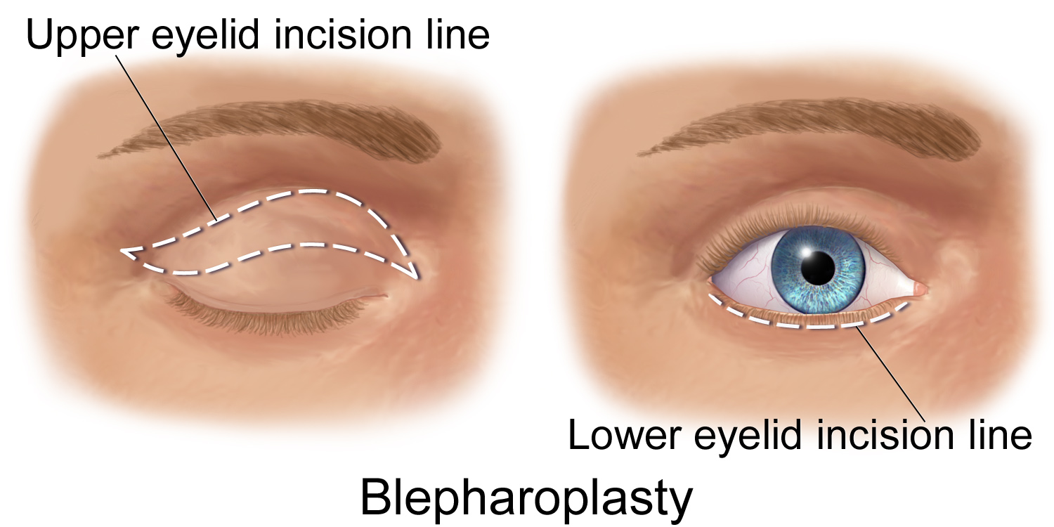 Medical illustration showing typical upper and lower eyelid blepharoplasty incision lines