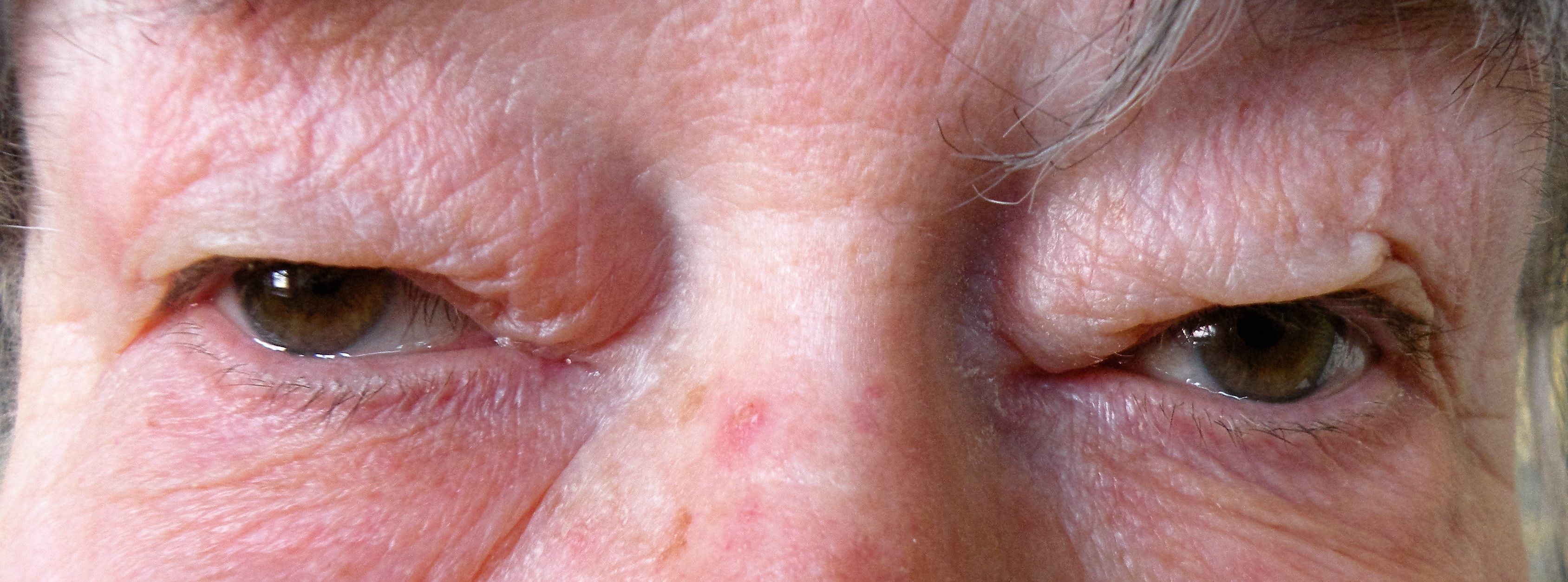 Close-up photo demonstrating upper-lid dermatochalasis with skin hooding