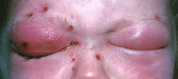 Clinical photograph with severe eyelid swelling and redness in orbital cellulitis