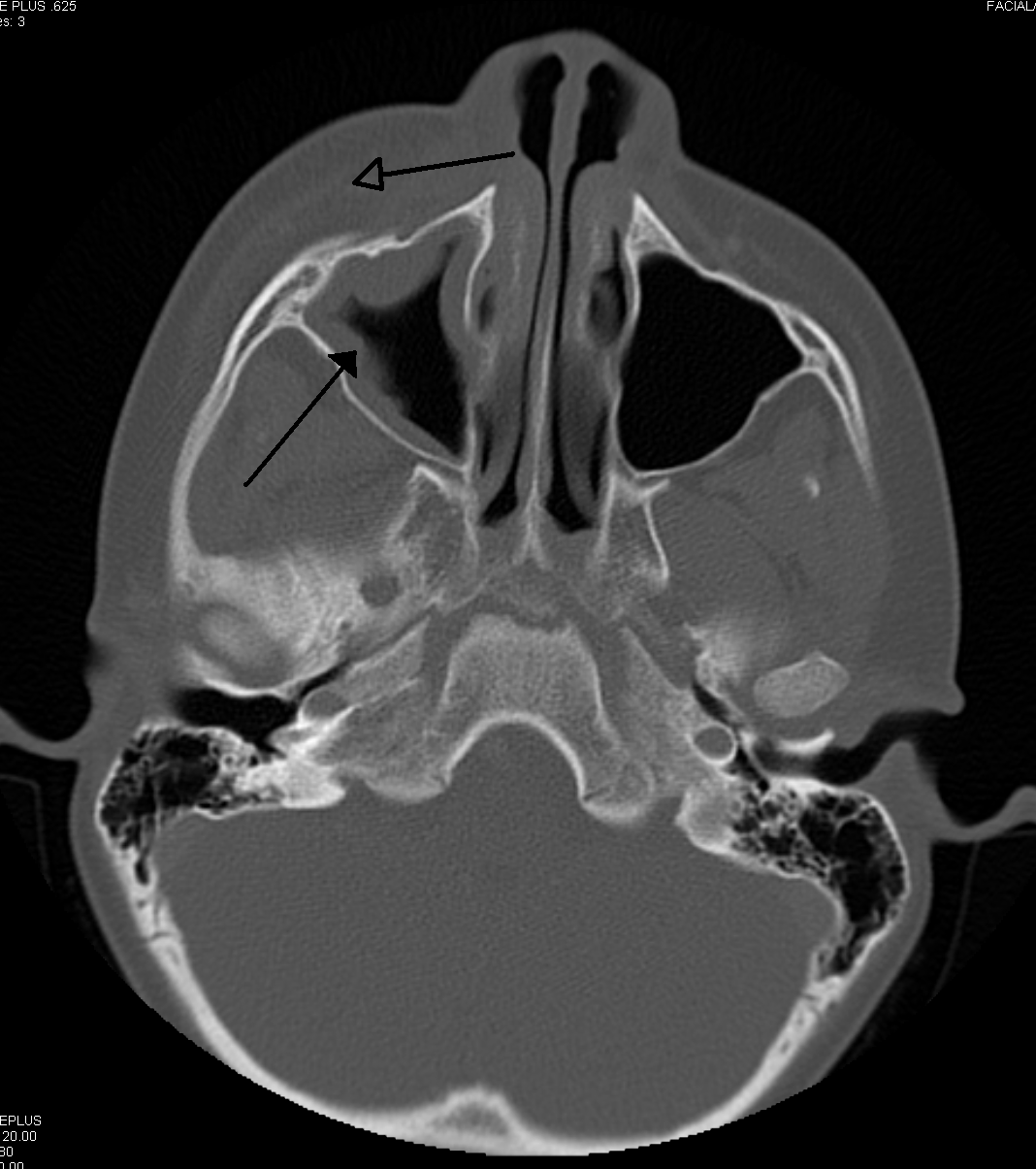 Axial CT of paranasal sinuses showing maxillary sinusitis with adjacent orbital cellulitis