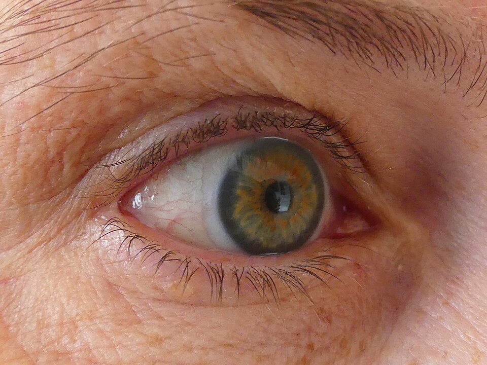 Close-up of an eye wearing a rigid gas-permeable contact lens