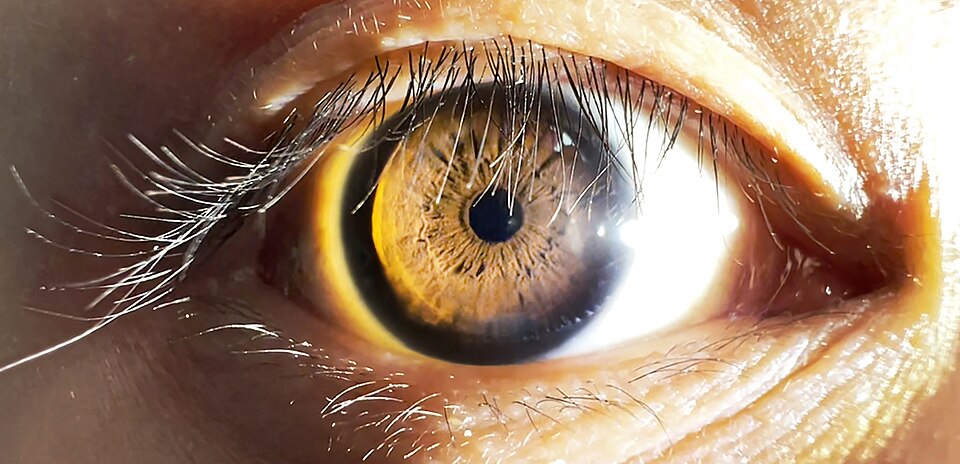 Close-up of an eye with a constricted pupil in bright light