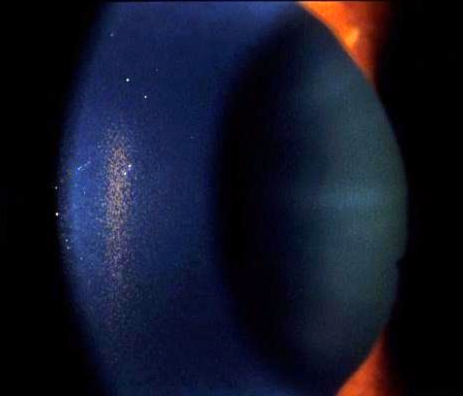 Slit-lamp photo showing a vertical spindle of pigment on the corneal endothelium (Krukenberg spindle)