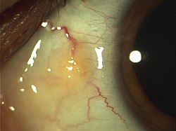 Slit-lamp image of a pinguecula under magnification.