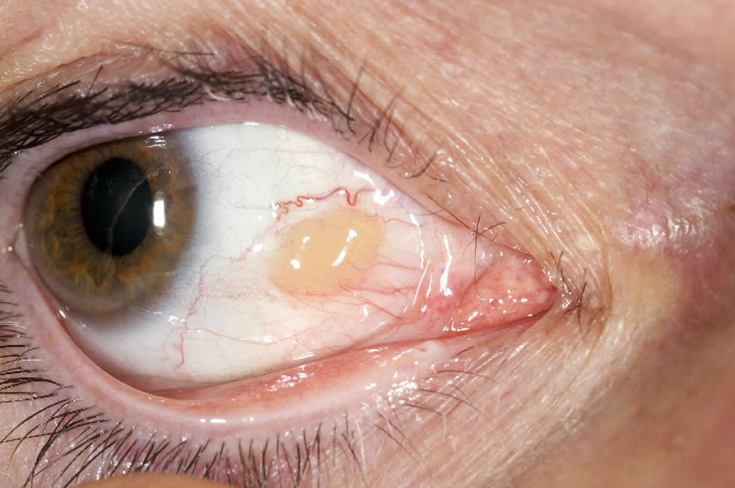 Close-up photograph of a nasal pinguecula on the sclera.