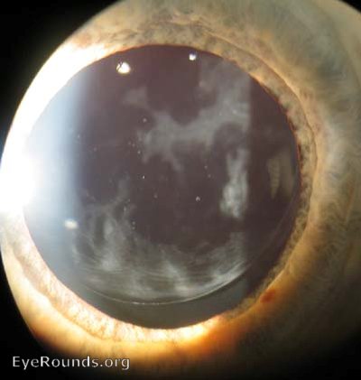 Slit-lamp photograph showing posterior capsular opacification behind an intra-ocular lens.