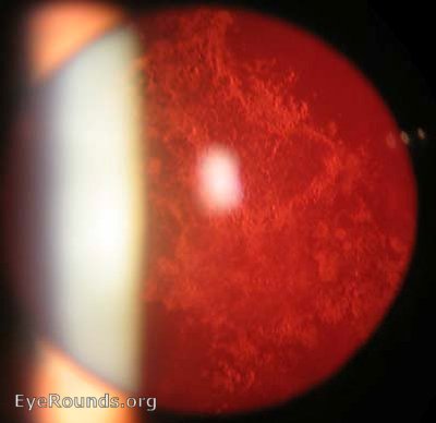 Retro-illumination view highlighting the opacified posterior capsule.