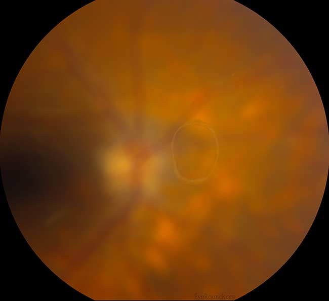 Fundus photograph showing a circular Weiss ring anterior to the optic disc.