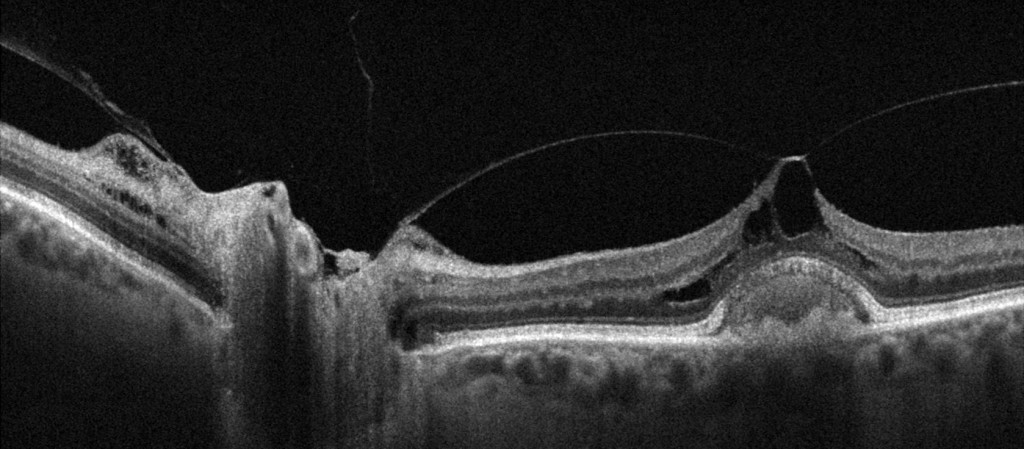 Optical coherence tomography scan with a crescent‑shaped detached posterior hyaloid membrane.