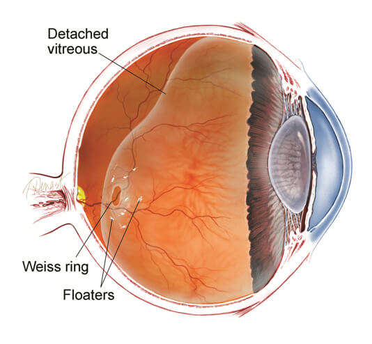 Cut‑away diagram of an eye showing detached vitreous gel, floaters and Weiss ring.