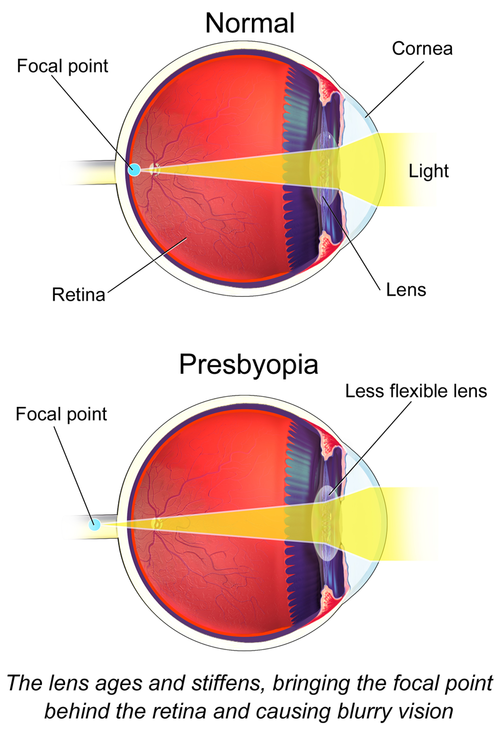 Illustration comparing light focus in a normal eye versus an eye with presbyopia