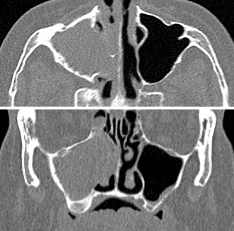 Axial and coronal CT images showing chronic maxillary sinusitis.
