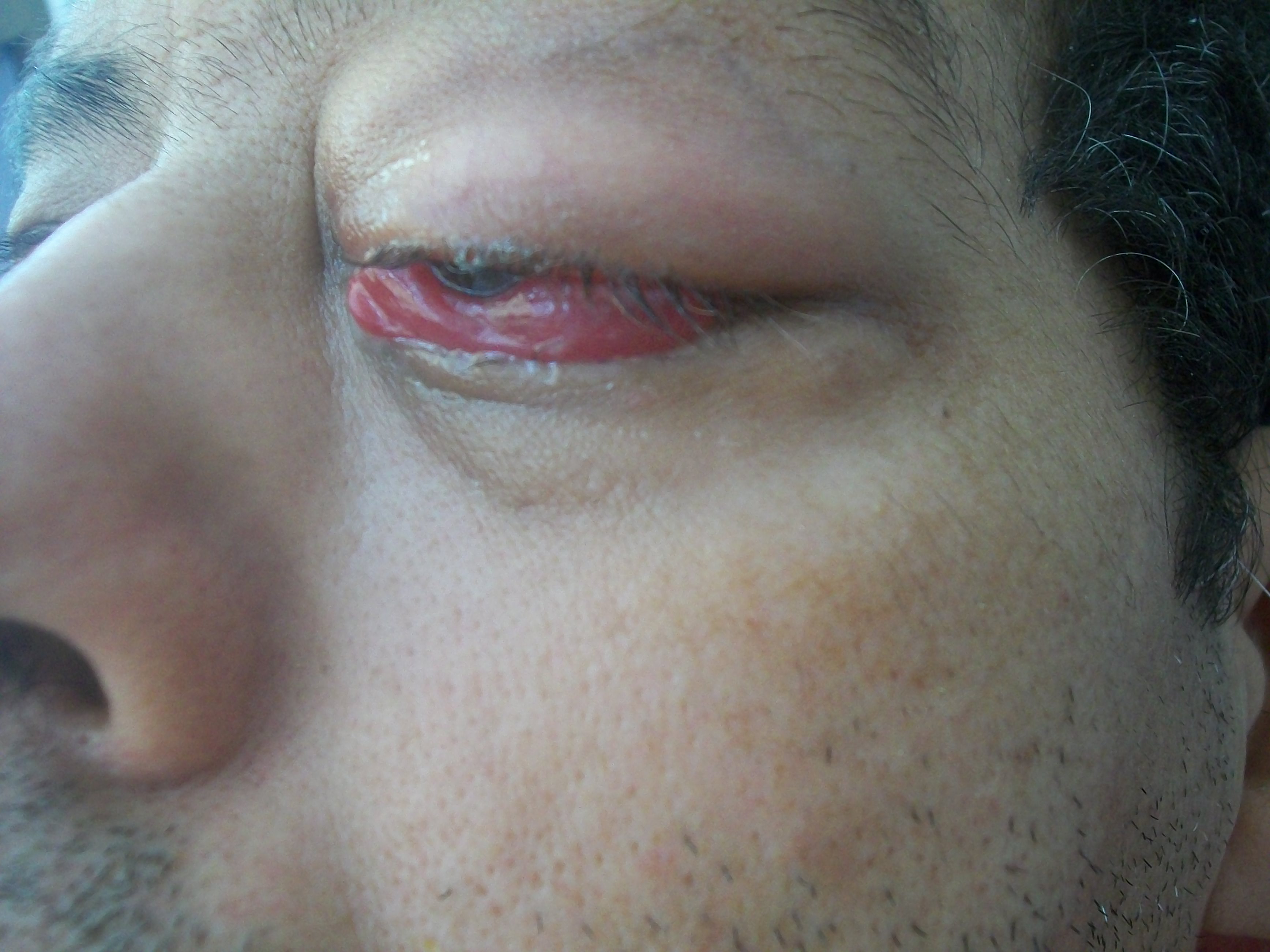 Left-eye periorbital cellulitis with eyelid swelling and redness.