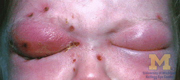 Patient with significant eyelid swelling from orbital cellulitis.