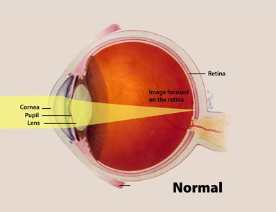 Cross-section diagram of a healthy eye showing light focus on the retina