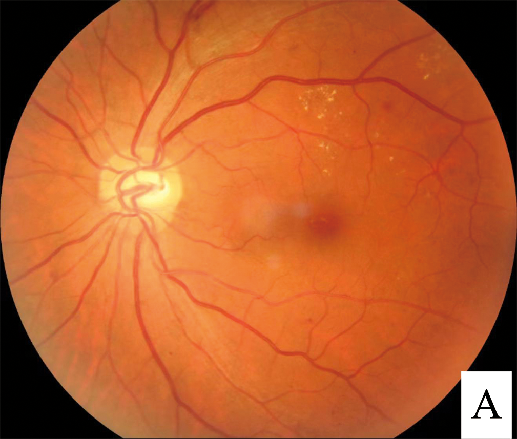 Color fundus image showing signs of diabetic retinopathy including exudates and small hemorrhages
