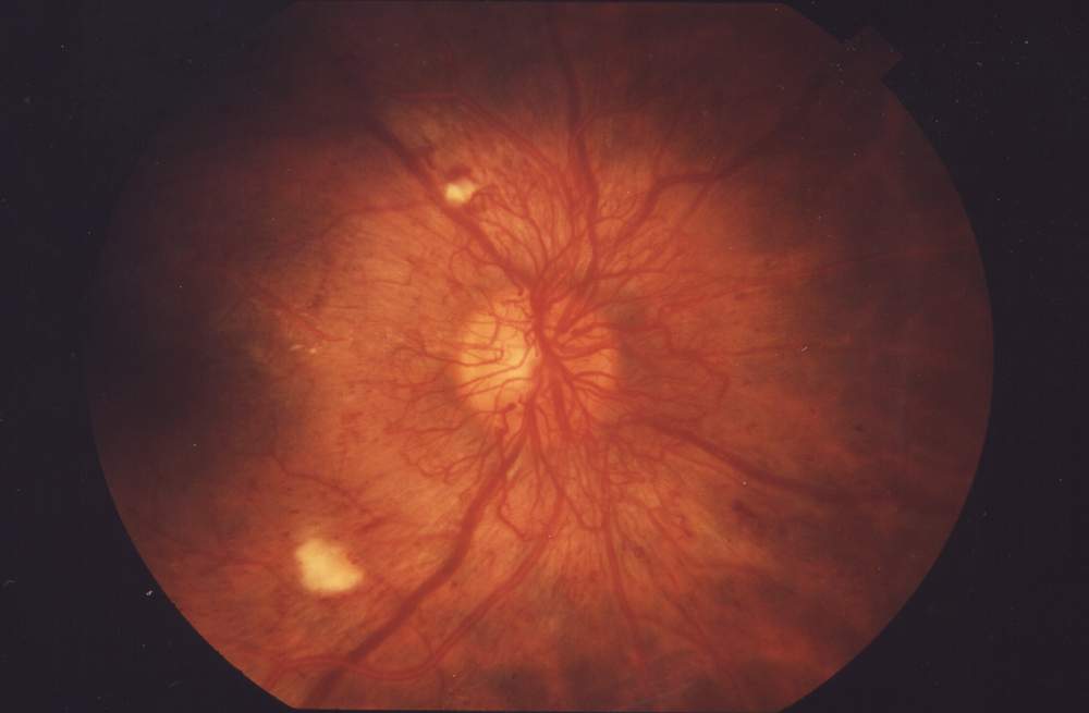 Fundus photograph showing proliferative diabetic retinopathy with new abnormal vessels