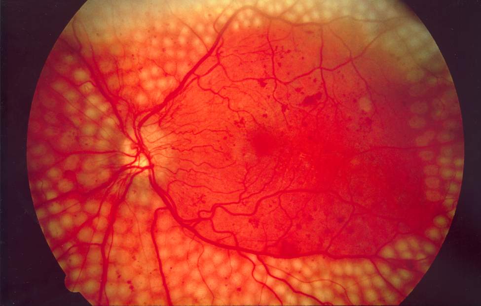 Fundus photograph after panretinal photocoagulation showing scatter laser scars