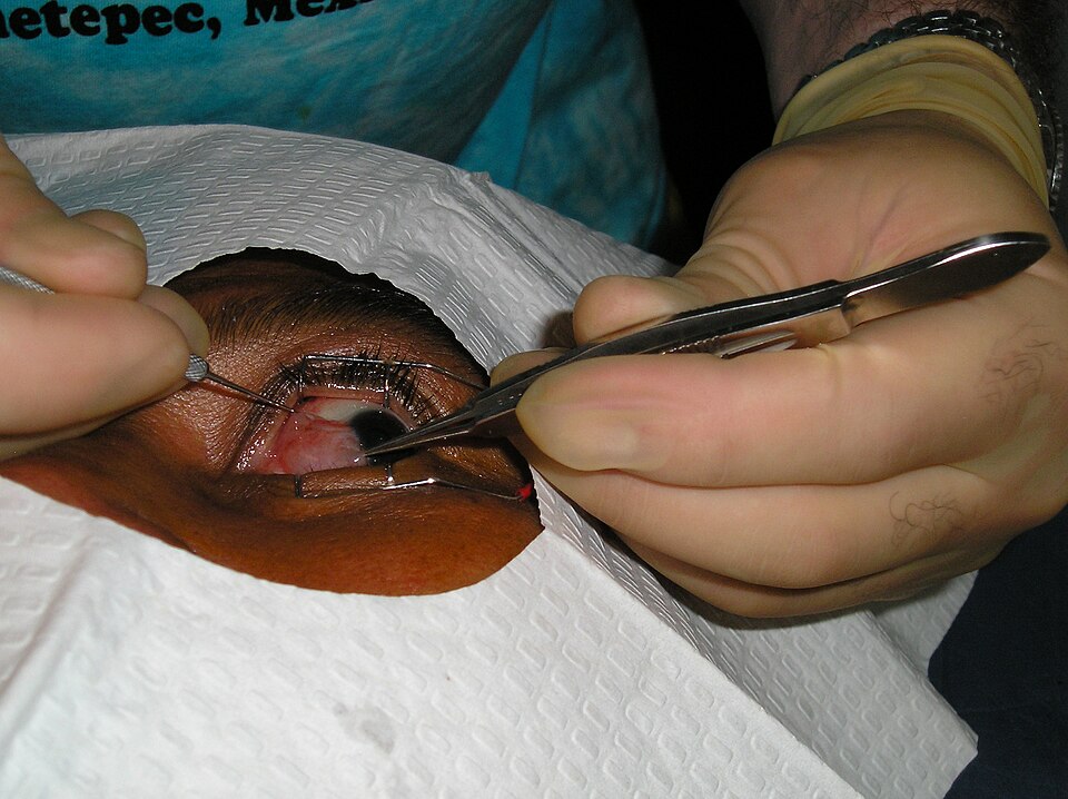 Advanced pterygium extending onto the cornea toward the pupil
