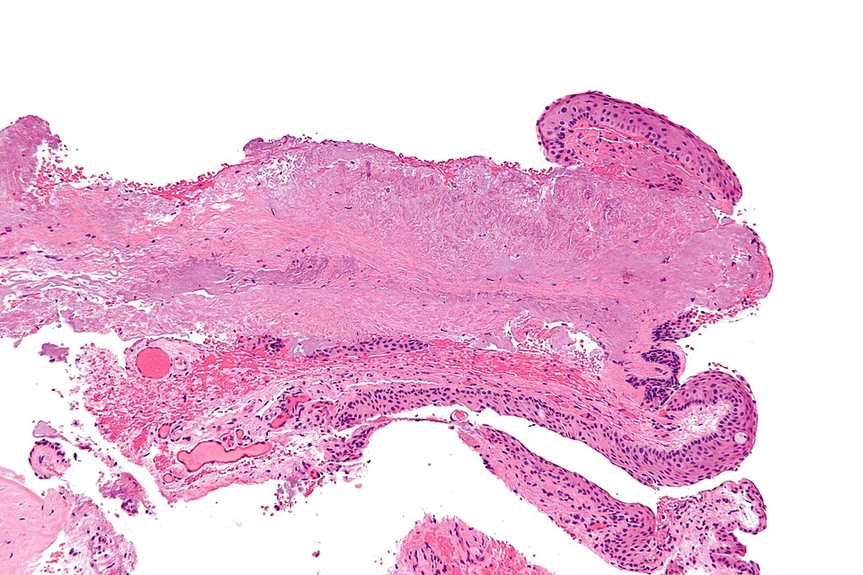 Intermediate-magnification histology slide of pterygium tissue stained with H&E