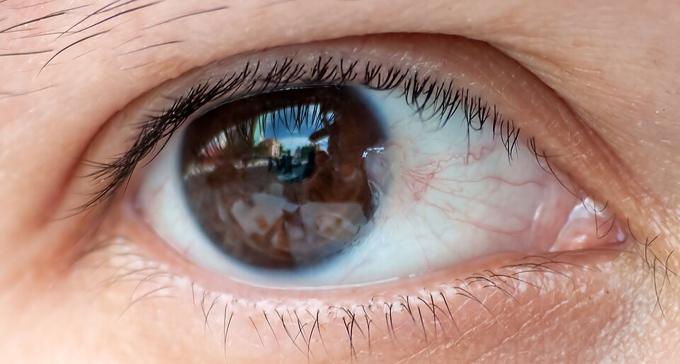 Close-up photograph of an eye with an early nasal pterygium just touching the cornea
