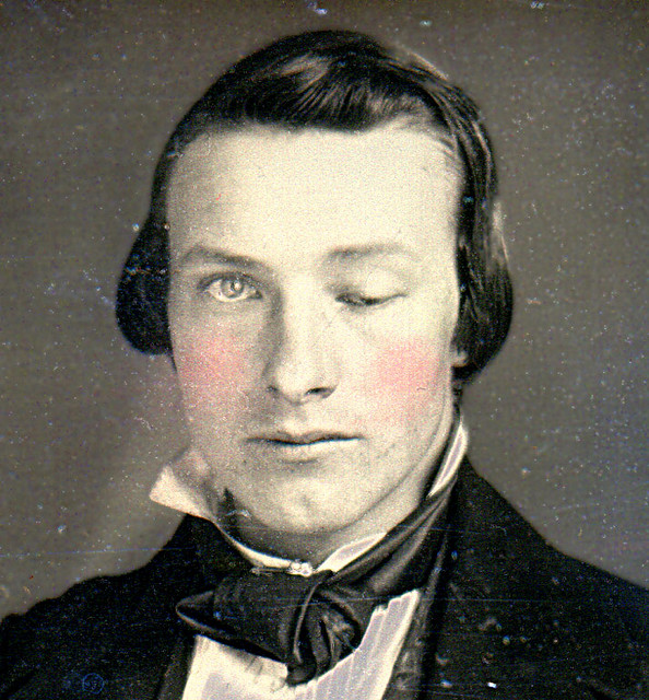 Historic daguerreotype of a young man with severe left-eye ptosis.