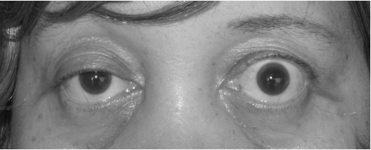 Close-up showing partial right-sided ptosis in myasthenia gravis.