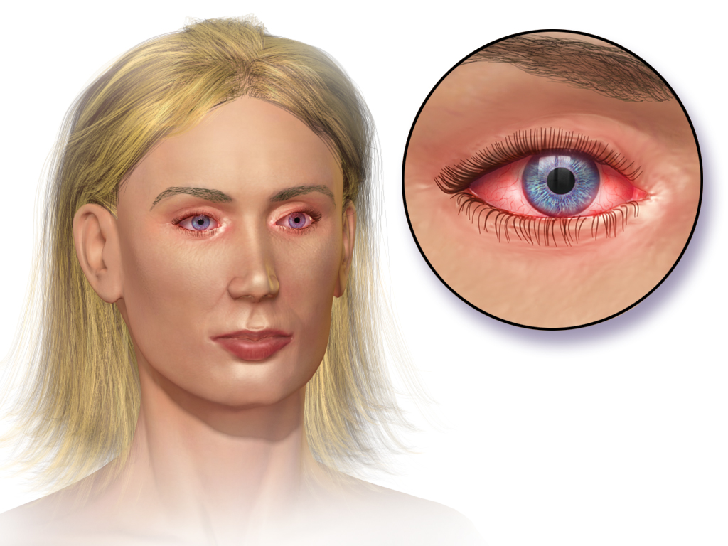Medical illustration of allergic conjunctivitis causing redness