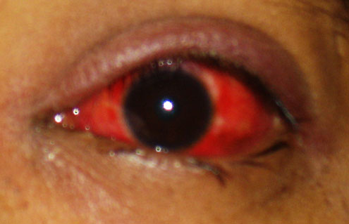 Close-up of an acutely inflamed red eye
