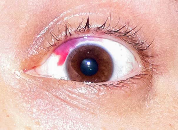 Subconjunctival hemorrhage showing bright red patch