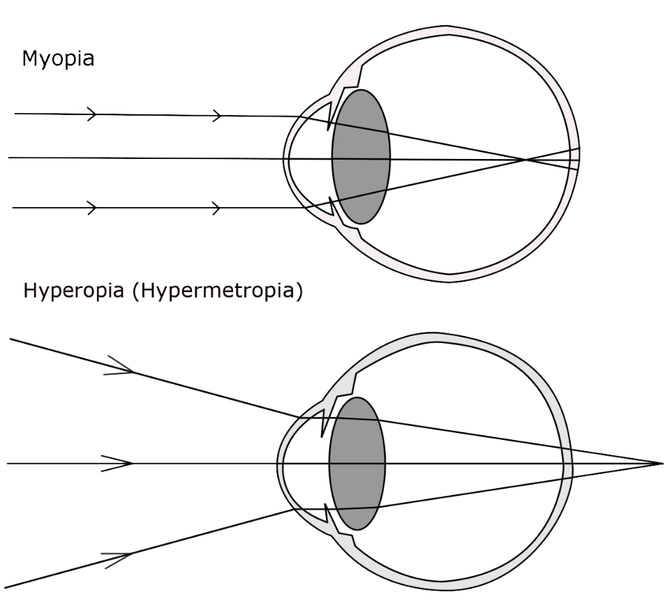 Graphic showing light mis-focusing in myopia and hyperopia