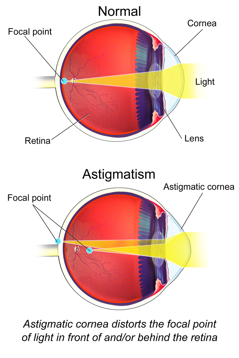 Illustration of normal eye versus astigmatic eye