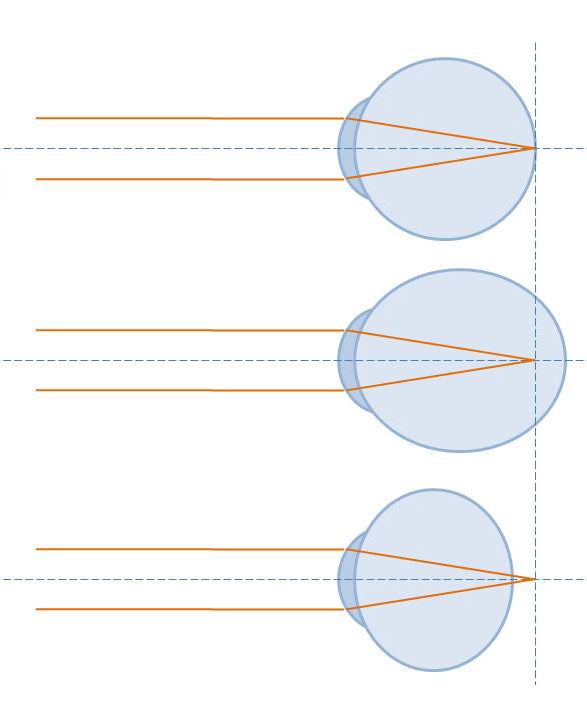 Diagram comparing normal focus with myopia and hyperopia in the eye