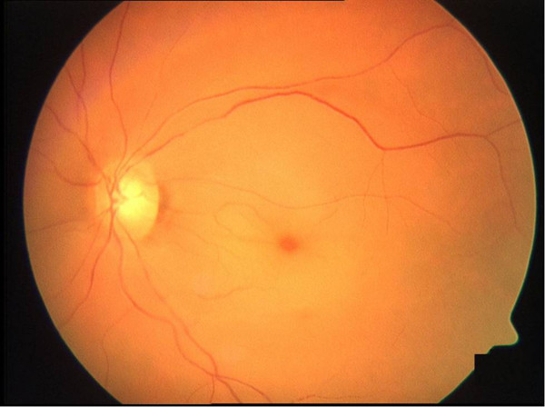 Fundus photo showing cherry-red spot and retinal whitening in CRAO