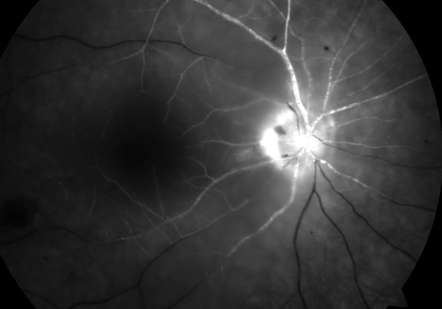 Fluorescein angiography showing delayed/poor retinal arterial filling in CRAO
