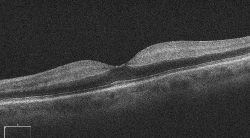 OCT scan of the macula with inner retinal hyperreflectivity in acute RAO