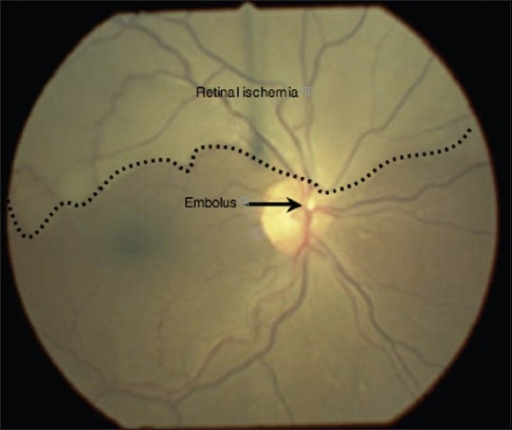 Fundus image labeled to show retinal ischemia and a Hollenhorst plaque embolus