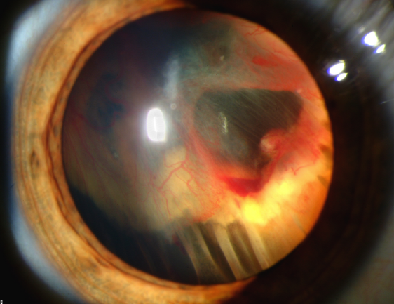 Slit-lamp photograph showing a fresh retinal detachment with hemorrhage inside the eye