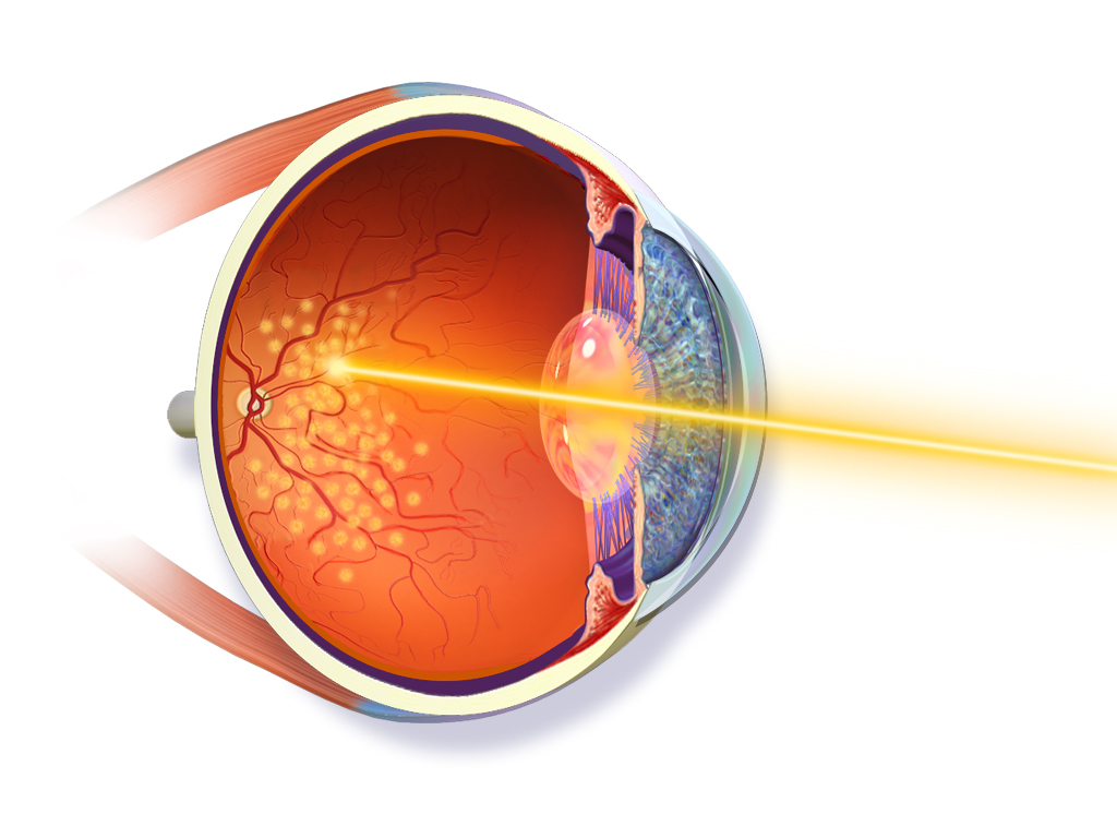 Diagram of laser photocoagulation creating a sealing scar around a retinal break